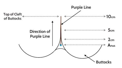 purple line dilation on dark skin|More.